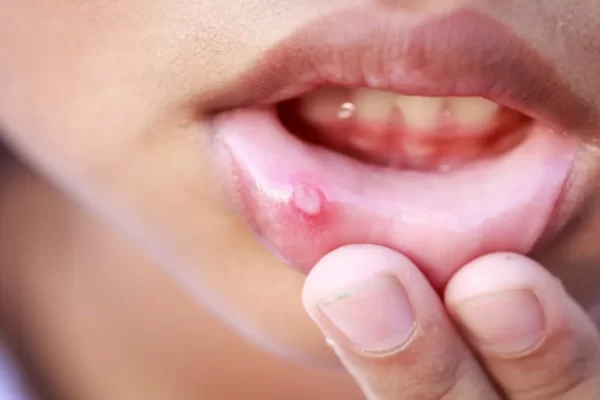 Treatment of Mouth Ulcer at home: पुराने से पुराने छाले होंगे गायब, आजमाएं इन नुस्खों को !